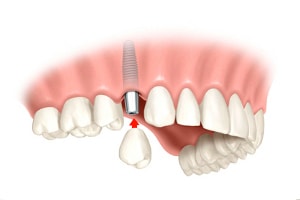 Coroana dentara pe implant